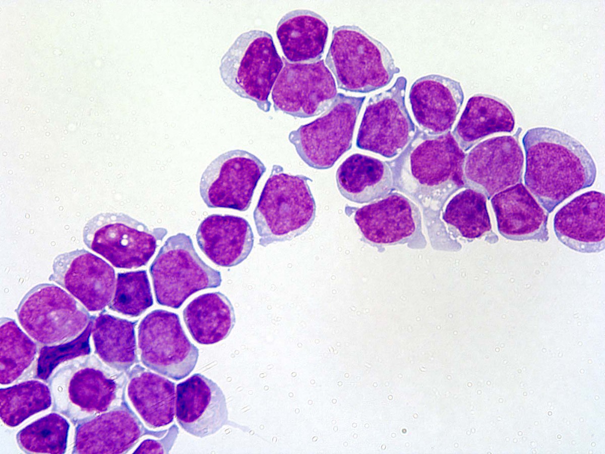 Figure 2. Cerebrospinal fluid cytospin showed abundant immature cells.